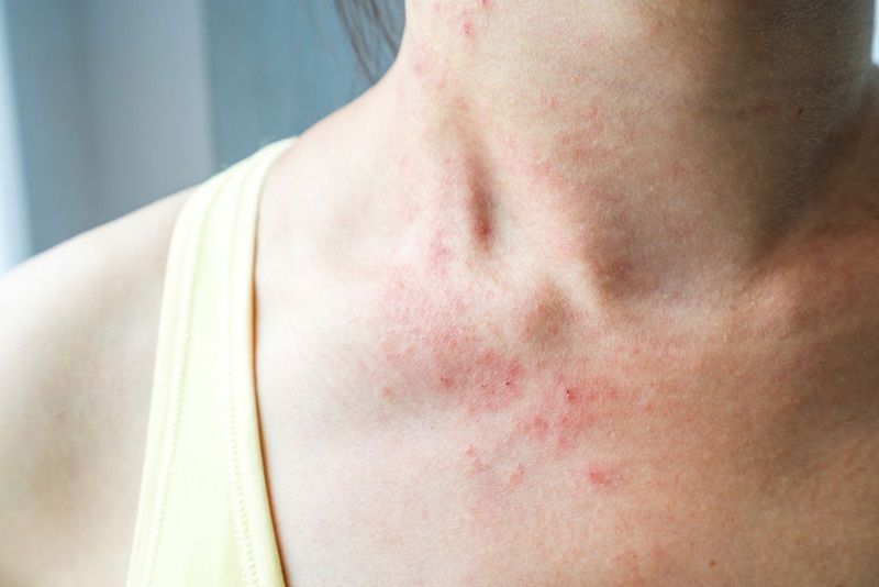 Dị ứng các loại hạt là gì? Có di truyền hay không? Nguyên nhân và triệu chứng