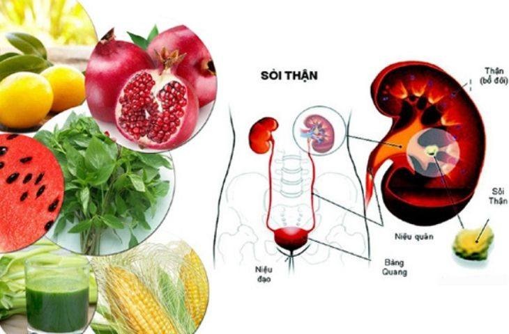 Biện pháp đơn giản hàng đầu giúp đẩy lùi sỏi thận