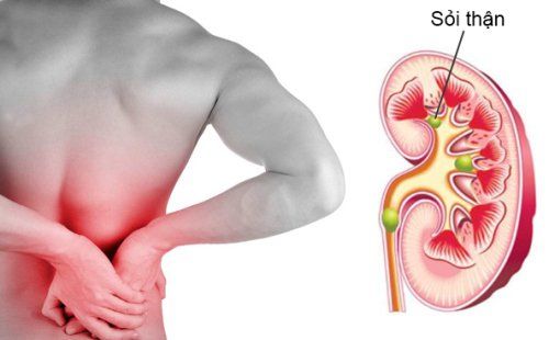 Sỏi thận có thể gây đái máu