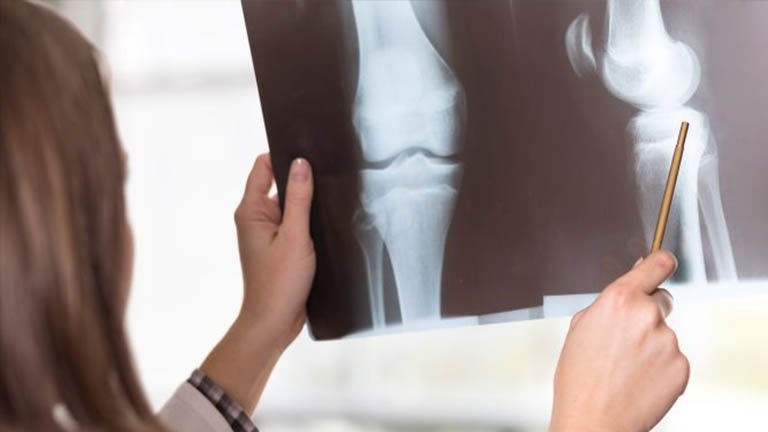 Nốt đặc xương là gì? Nguyên nhân, triệu chứng và cách phòng ngừa
