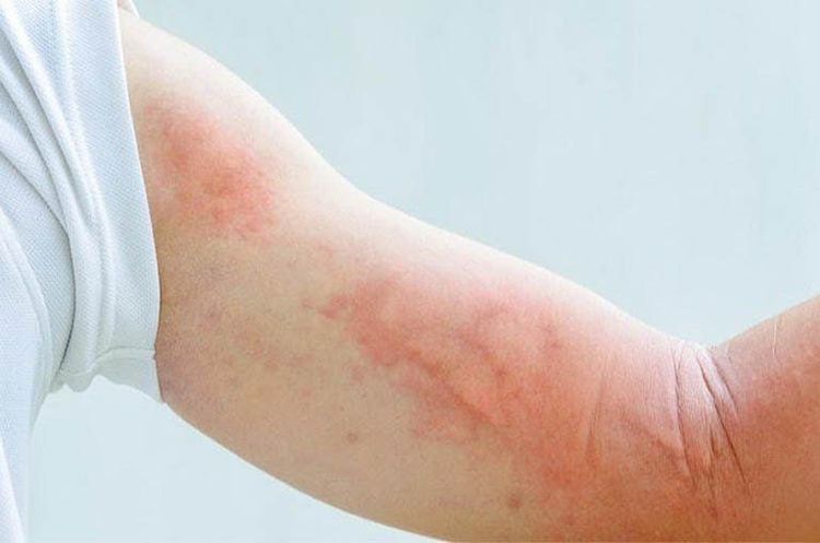 Uống thuốc tamsulosin có thể gây ra tác dụng phụ phát ban, mẩn đỏ da