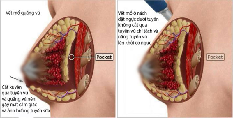 đặt túi ngực dưới tuyến