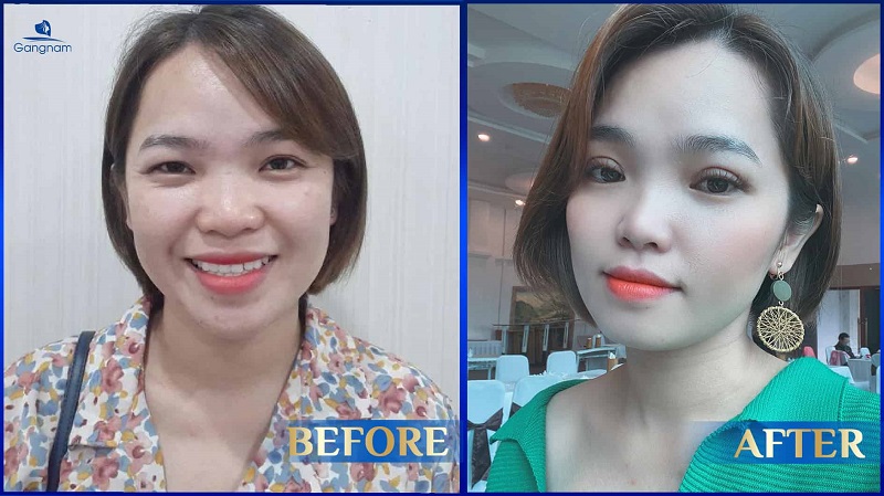 Mở góc mắt có ảnh hưởng đến thị lực không?