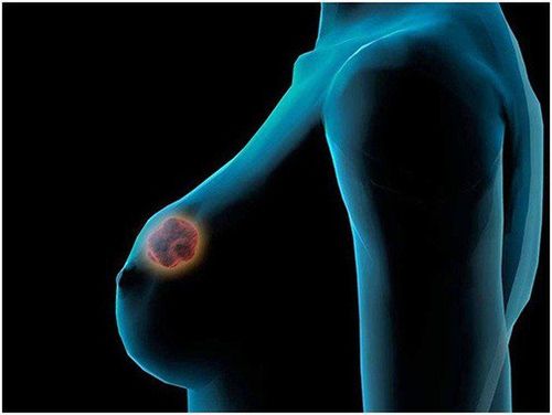 Tư thế chụp X quang tuyến vú (mammography)
