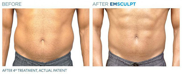 Sự thay đổi sau một liệu trình 4 buổi với EMSculpt.