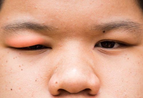 Lý do khiến khuôn mặt của bạn sưng phù