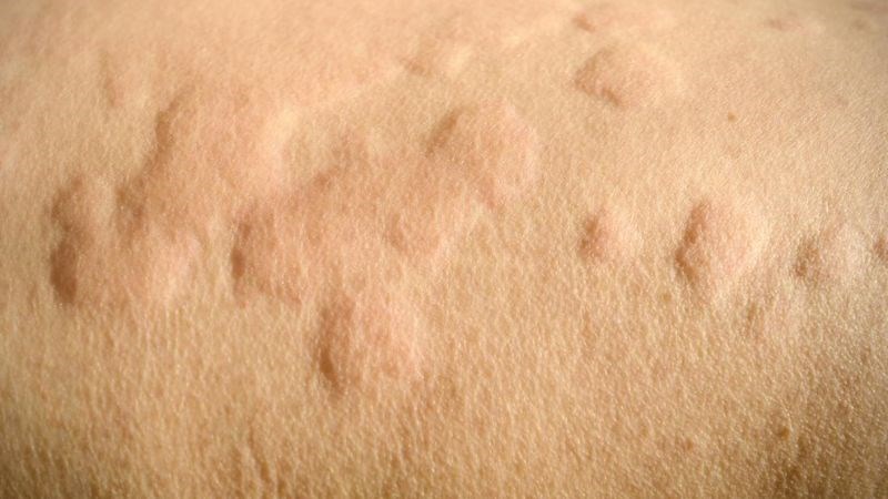Dị ứng da là một rủi ro tiềm ẩn của việc ngủ nude